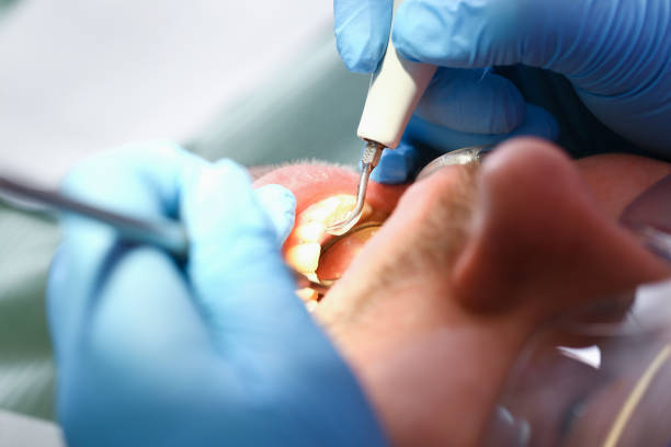 Best Emergency Wisdom Teeth Removal in Luckey, OH